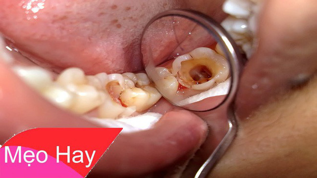 Cổ phương kỳ diệu: Cách làm giảm đau răng nhanh chóng, hiệu quả theo bí quyết Đông y xưa - Ảnh 1.